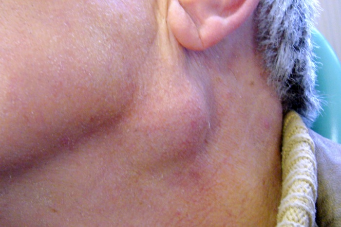 Neck Lump